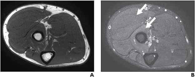 Axial T1-weighted (A) and STIR (B) images depict denervation edemalike signal of extensor muscles of dorsal and mobile wad compartments with no fatty infiltration or atrophy consistent with NS-RADS M1.