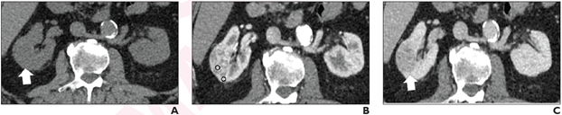 a 5-tiered CT scoring algorithm may represent a clinically useful tool for diagnosis of clear-cell renal cell carcinoma (RCC) in small (≤4 cm) solid renal masses. 