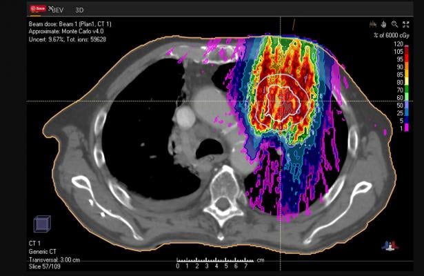 ASTRO Updates Guidelines for Palliative Lung Radiation Therapy