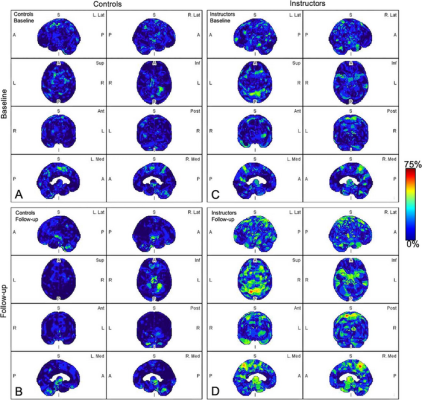 Parametric maps of amyloid deposition in healthy control participants (A and B) and blast-exposed military instructors (C and D) at baseline (A and C) and follow-up (B and D). The blue-to-red scale indicates the frequency of statistically abnormal amyloid uptake in a particular brain voxel. Whereas no abnormal amyloid uptake was identified at baseline or follow-up in healthy control participants (A, B), amyloid deposition occurred most frequently in blast-exposed participants in the superior parietal lobule