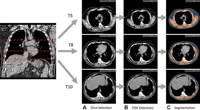 Artificial intelligence (AI) can use data from low-dose CT scans of the lungs to improve risk prediction for death from lung cancer, cardiovascular disease and other causes 