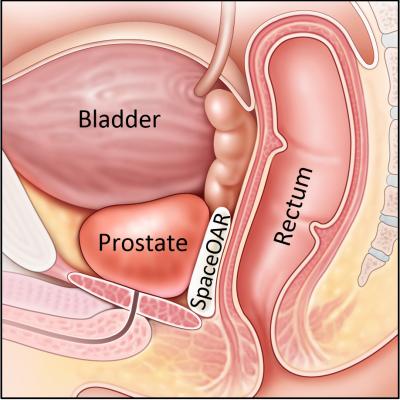 New Prostate Cancer Radiotherapy Technique Aims to Preserve Sexual Function