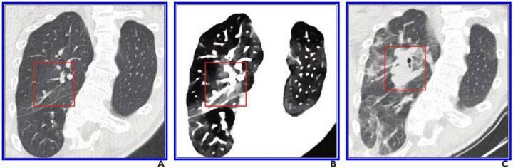 A, Initial conventional axial CT image shows no noticeable lung damage (within red box) in right upper lobe. B, Electron density spectral CT image obtained at same time as image in A shows lesions (within red box) in right upper lobe. C, Follow-up conventional axial chest CT image obtained 5 days after images in A and B confirm presence of lesions (within red box) in right upper lobe.