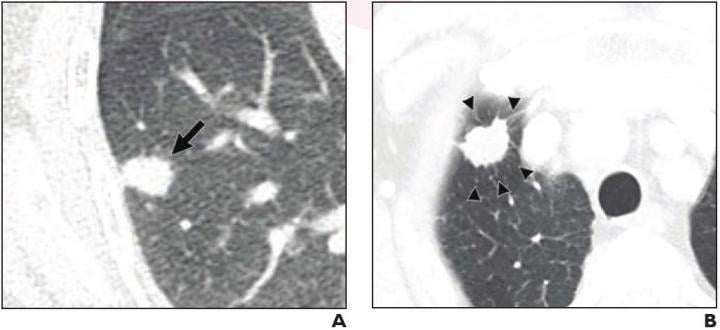 (A) 70-year-old woman with pulmonary adenocarcinoma who underwent sublobar resection without evidence for pLVI. 15-mm solid nodule with irregular margins present in right lower lobe (arrow). No tumor recurrence on 37-month follow-up. (B) 75-year-old man with pulmonary adenocarcinoma who underwent wedge resection that exhibited pLVI. 19-mm solid nodule with irregular margins and peritumoral interstitial thickening (arrowheads) present in right upper lobe. Ipsilateral mediastinal and hilar lymph node metastas