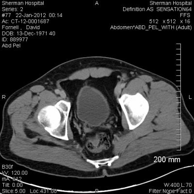 ultrasound systems, postoperative urinary retention, study