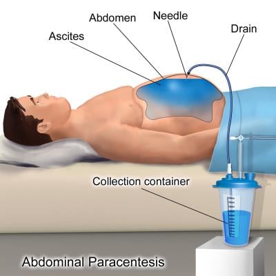 Study Finds Growth in Paracentesis and Thoracentesis Procedures