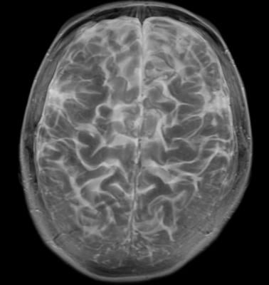 IED, intermittent explosive disorder, brain volume, University of Chicago study, fMRI