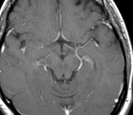 MRI, brain damage, heart disease protein, NT-proBNP, Radiology journal