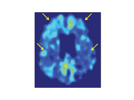New PET Image Analysis Technique Tracks Amyloid Changes With Greater Power