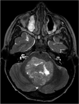 radioguided brain surgery, RGS, tracer, oncology, radiation therapy, DOTATOC