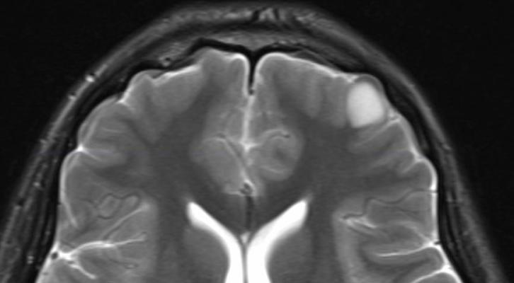 New Standardized Brain Tumor MRI Recommendations Announced ...