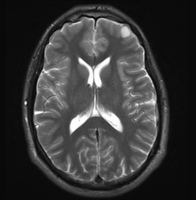 whole brain radiotherapy, WBRT, metastatic lung cancer, The Lancet study, supportive care