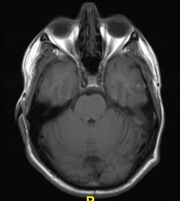 MRI, brain scans, shrinkage, dementia with Lewy bodies, Alzheimer's disease, Neurology journal study