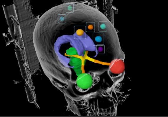 First Patient Enrolled in World's Largest Brain Cancer Clinical Trial