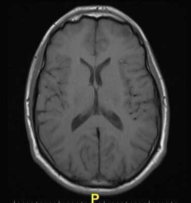 brain rust, MRI, schizophrenia, American College of Neuropsychopharmacology, ACNP, Fei Du