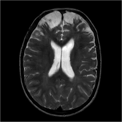 brain with chronic traumatic injury