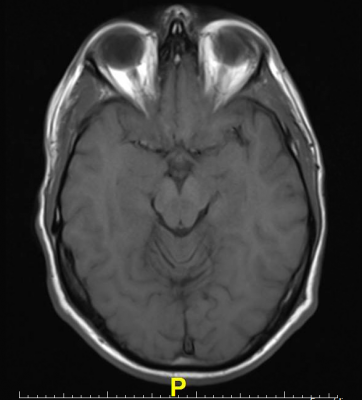 Oxford University Research Brain MRI Resting-state fMRI Parkinson's