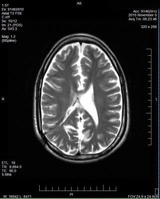 multiple sclerosis, MS, T2-weighted MRI, University of Nottingham study