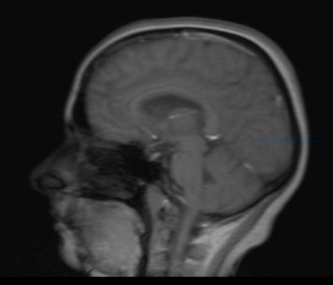 UC Irvine study, UCI, Toshiba, high school football players, cerebral microbleeds, CMB