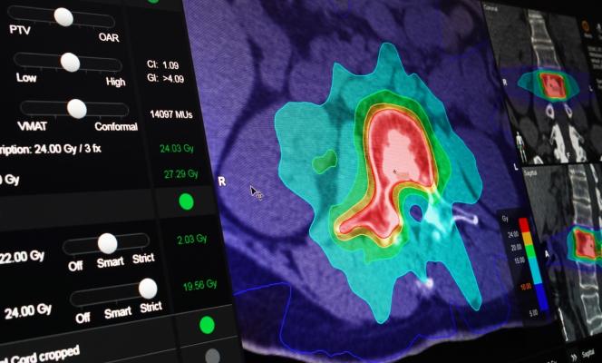 BrainLAB Announces FDA Clearance For Two New Indication-Specific Radiosurgery Software Applications