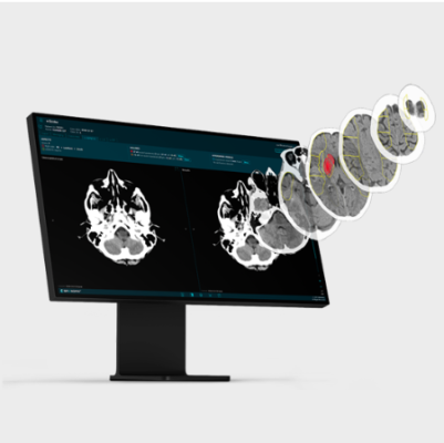  AI Technology Helps Reveal Efficacy of Neuroprotective Drug Candidate in Severe Acute Ischemic Stroke Patients