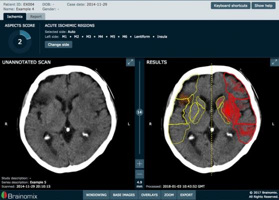 Brainomix Secures $9.8m Investment to Tackle Strokes With AI