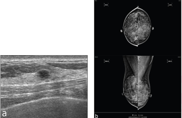 Findings from an accepted manuscript published in the American Journal of Roentgenology (AJR) suggest that for patients with dense breasts undergoing screening in the incidence setting, a commercial AI tool did not provide additional benefit to mammography with supplementary ultrasound (US). 
