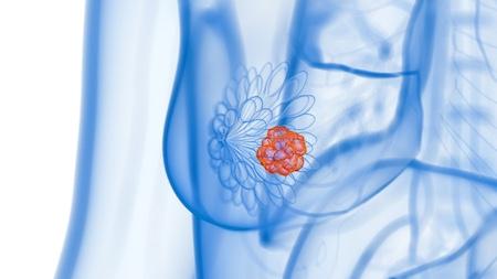 Targeted Radioimmunotherapy Regimen Achieves Complete, Durable Response in Breast Cancer Model