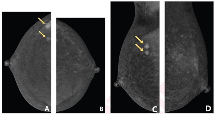 48-year-old woman who underwent CEM to evaluate two masses (arrows) in right breast. CEM obtained in following order: (A) craniocaudal (CC) view of right breast; (B) CC view of left breast; (C) mediolateral oblique (MLO) view of right breast; and (D) MLO view of left breast. Degree of background parenchymal enhancement (BPE) increases over time after contrast agent injection. (A) CC view of right breast shows mild BPE, whereas subsequently obtained (B) CC view of left breast shows moderate BPE. 