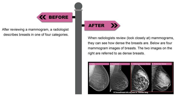 When radiologists review mammograms, they can see how dense the breasts are. Below are four mammogram images of breasts. The two images on the right are referred to as dense breasts. 