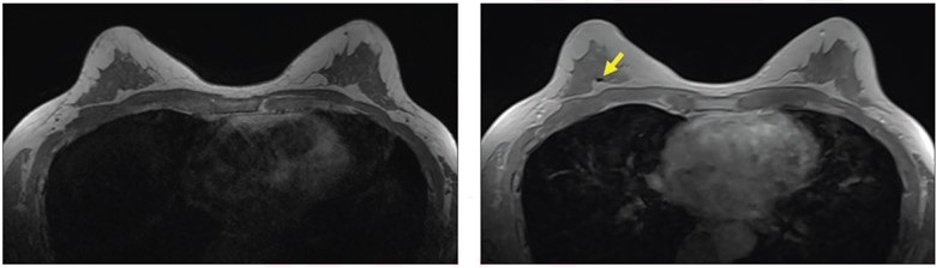 57-year-old patient with breast biopsy clips who underwent breast MRI for high-risk screening. A. Axial T1-weighted non-fat-saturated MR image shows no area of signal void. No reader detected clip using this sequence. B. Axial contrast-enhanced in-phase Dixon image shows signal void in right breast (arrow), which corresponded with MammoMark/CorMark Bread Tie biopsy clip. All three readers detected clip on this sequence, with confidence scores of 4, 3, and 2; assessments all classified as true positives (i.e