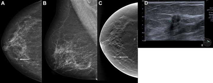 Images in a 68-year-old woman with a screen-detected ductal carcinoma in situ with an artificial intelligence (AI) score of 10 on the screening mammograms.