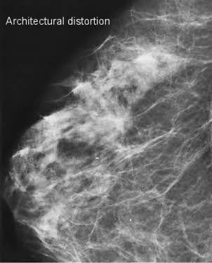 Managing Architectural Distortion on Mammography Based on MR Enhancement