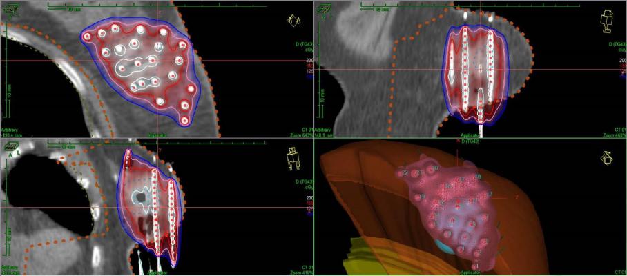 Breast brachytherapy, partial breast irratiation