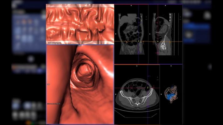 An update to the CT Colonography Reporting and Data System (C-RADS) was published Jan. 30 in the journal Radiology. According to a written statement from the Radiological Society of North America (RSNA), “CT Colonography Reporting and Data System (C-RADS): Version 2023 Update,” provides useful insights gained since the implementation of the original system in 2005.
