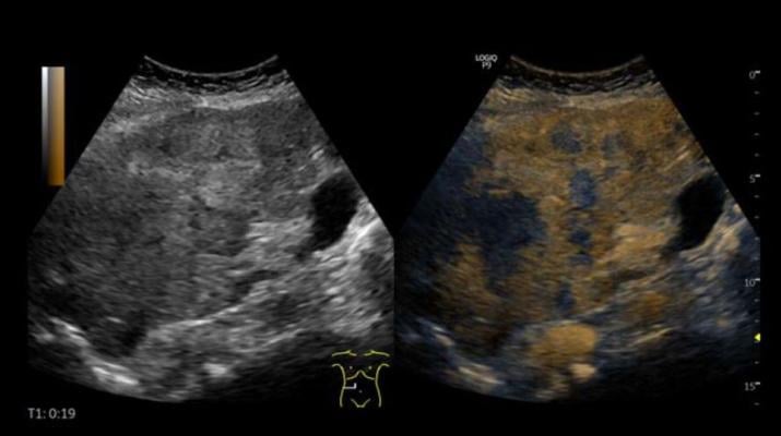 Contrast-enhanced ultrasound (CEUS) is more accurate and reliable than MRI for examining certain liver and kidney nodules 