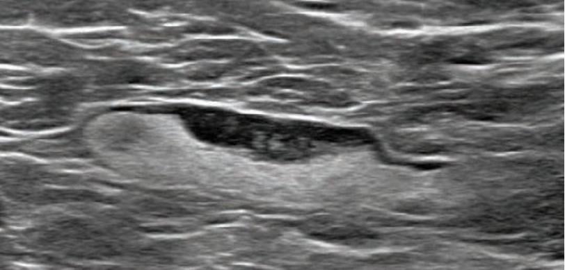 55-year-old woman who underwent screening mammogram and ultrasound 7 days after first COVID-19 vaccination dose. Screening mammogram and US demonstrated unilateral left axillary lymph node with cortical thickness of 5 mm on ultrasound (not shown). BI-RADS category 0 was assigned. Ultrasound from diagnostic work-up performed 7 days later showed no change in lymph node size. BI-RADS 3 was assigned. #COVIDvaccine #COVID19