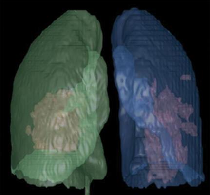 Artificial intelligence (AI)-assisted software was used to identify inflammatory tissues in lung and automatically segment inflammatory lesions. Three-dimensional image shows regions of COVID-19 pneumonia in lung through AI postprocessing. Image courtesy of the American Journal of Roentgenology (AJR)