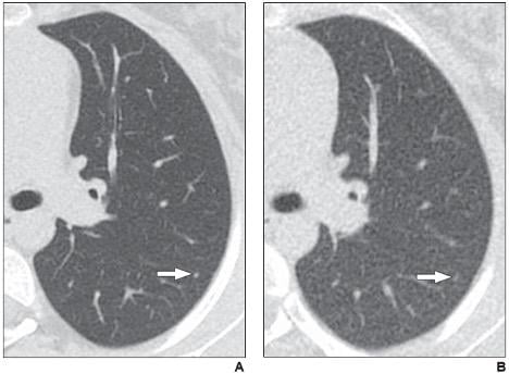 According to ARRS’ American Journal of Roentgenology (AJR), reduced-dose CT depicts greater than 90% of lung nodules in children and young adults with cancer, identifying the presence of nodules with moderate sensitivity and high specificity.