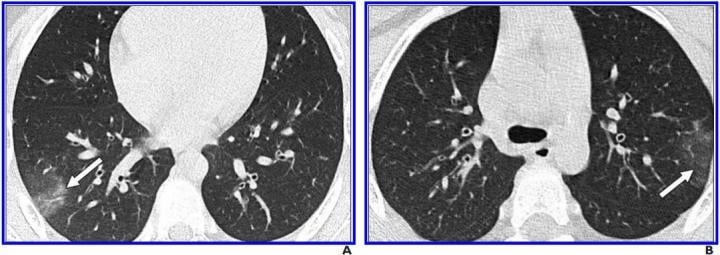 Largest case series (n=30) to date yields high frequency (77%) of negative chest CT findings among pediatric patients (10 months-18 years) with COVID-19, while also suggesting common findings in subset of children with positive CT findings
