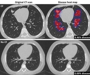 Thirona, an artificial intelligence (AI) software company specialising in medical image analysis, developed an AI algorithm that revolutionizes cystic fibrosis (CF) care. The new algorithm, coined PRAGMA-AI, allows for fast, automated analysis of CT scans of patients with CF to detect and quantify lung abnormalities related to CF