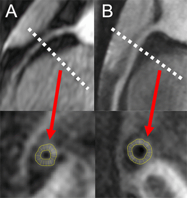 Early coronary disease and impaired heart function, with increased coronary vessel wall thickness, in asymptomatic, middle-aged individuals living with HIV has been reported in a new study published today in Radiology: Cardiothoracic Imaging, a journal of the Radiological Society of North America (RSNA).