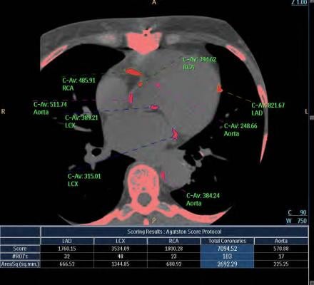 CT Calcium Screening for Heart May Lead to Treatments | Imaging Technology News