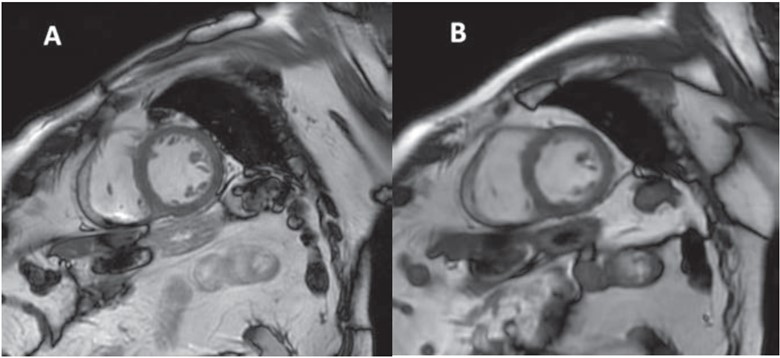 85-year-old patient with ischemic heart disease, who underwent cardiac MRI at 3 T
