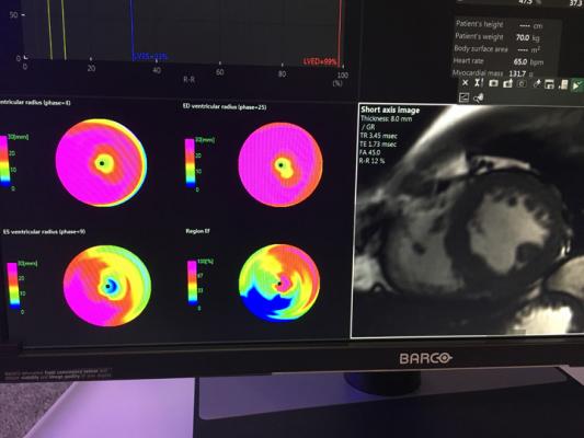 Machine Learning Could Offer Faster, More Precise Cardiac MRI Scan Results