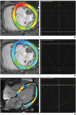 80-year-old patient with nonischemic dilated cardiomyopathy. Ejection fraction was 25.2%. Patient underwent cardiac MRI. A. Radial strain overlay on short-axis cine image and corresponding graph show global radial strain measurement, yielding value of 10.8%. B. Circumferential strain overlay on short-axis cine image and graph show global circumscribed strain measurement, yielding value of -8.5%. C. Longitudinal strain overlay on 4-chamber cine image and graph show global longitudinal strain measurement, yie