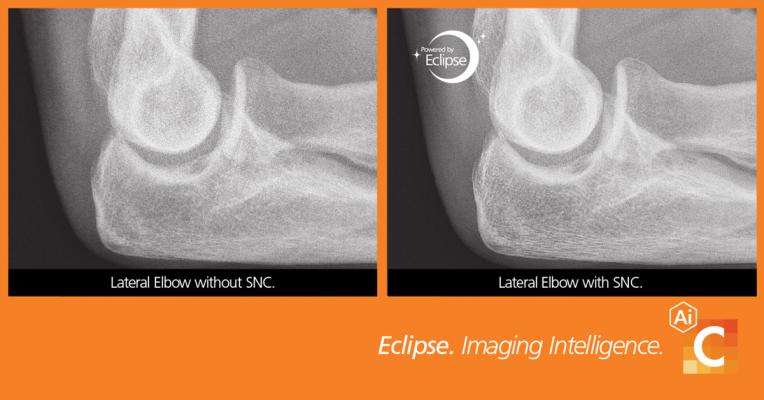 Carestream’s AI features are powered by Eclipse—the engine behind the company’s cutting-edge imaging software platforms—that uses proprietary algorithms and AI to amplify the value of the entire imaging chain. 