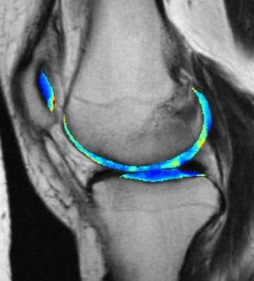 The cartilage in this MRI scan of a knee is colorized to show greater contrast between shades of gray.