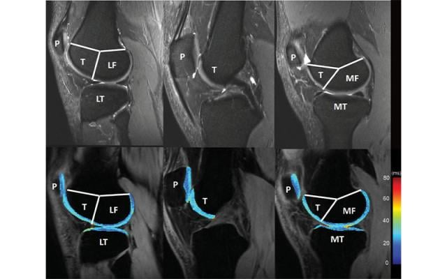 New recommendations will help provide more reliable, reproducible results for MRI-based measurements of cartilage degeneration in the knee, helping to slow down disease and prevent progression to irreversible osteoarthritis, according to a special report published in the journal Radiology