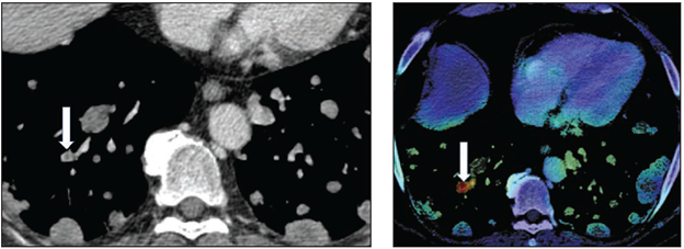 According to ARRS’ American Journal of Roentgenology (AJR), an AI tool for detection of incidental pulmonary embolus (iPE) on conventional contrast-enhanced chest CT examinations had high NPV and moderate PPV, even finding some iPEs missed by radiologists 